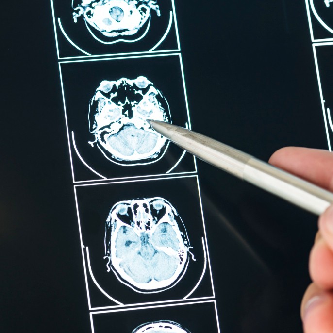 Tampilan dekat hasil scan MRI otak