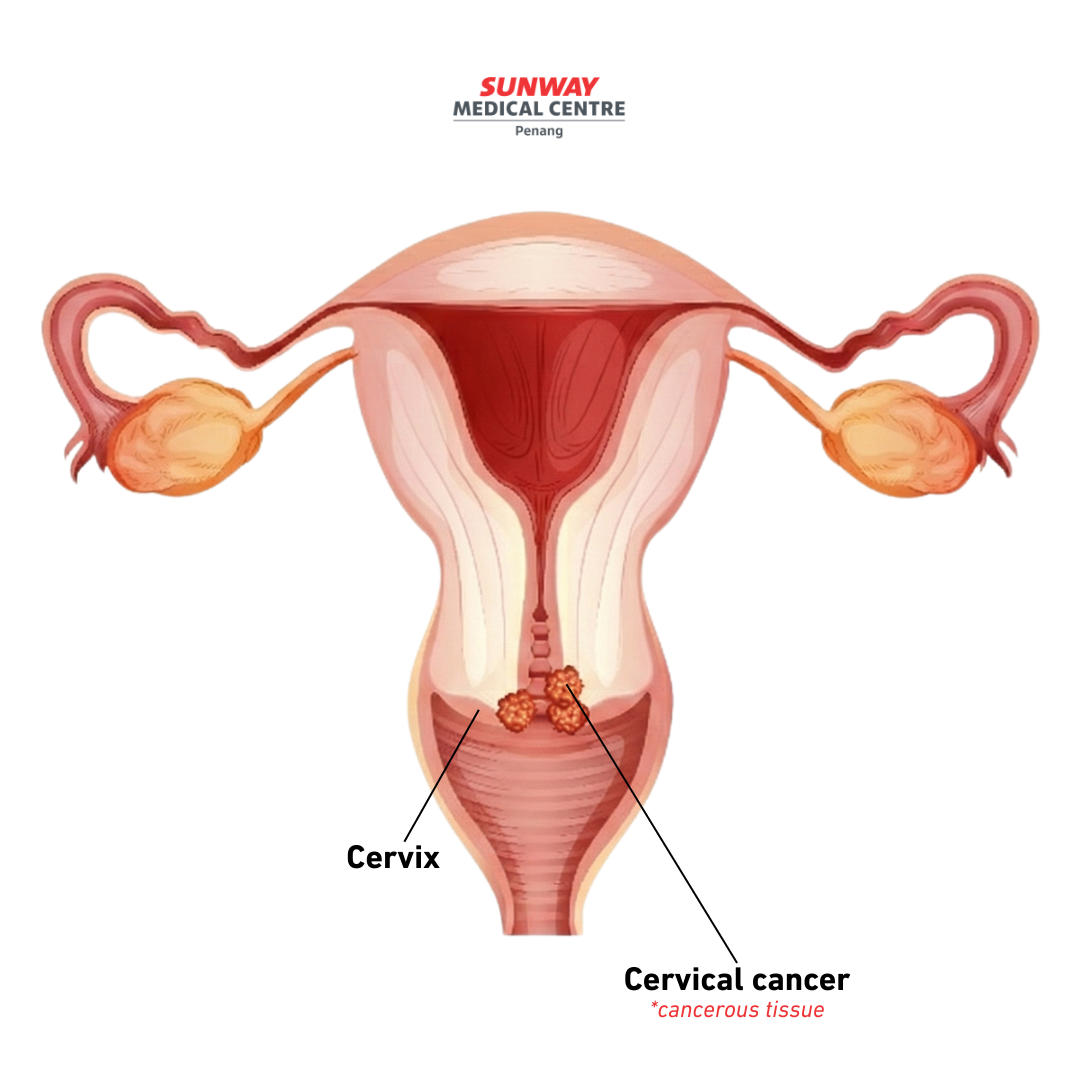Cervical cancer diagram - Cancerous tissue on the surface of cervix